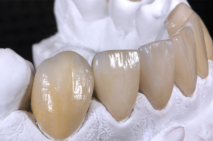 Ceramica VITA Ambria