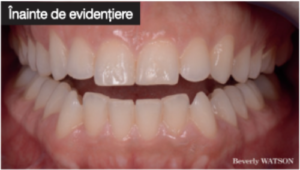 Guided Biofilm Therapy