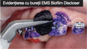 Guided Biofilm Therapy