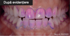 Guided Biofilm Therapy