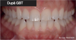 Guided Biofilm Therapy