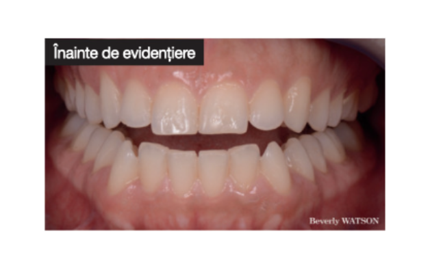 De ce și cum să utilizezi un agent de evidențiere - Guided Biofilm Therapy by EMS