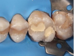 Obturarea întregii cavități cu Biodentine