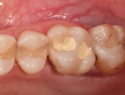 Restaurarea pe termen lung cu Biodentine