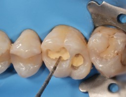 Dintele după îndepărtarea a 1,5 mm Biodentine