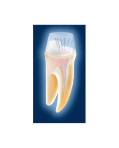 Voco Rebilda Post GT 1.4mm fascicul pivoti fibra de sticla